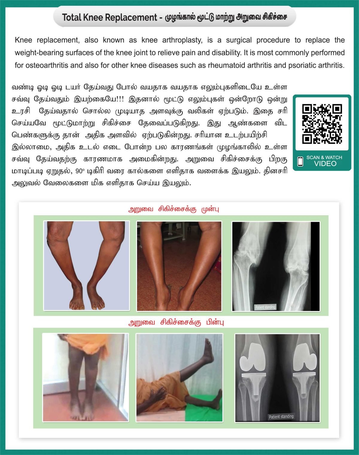 Total Knee Replacement
